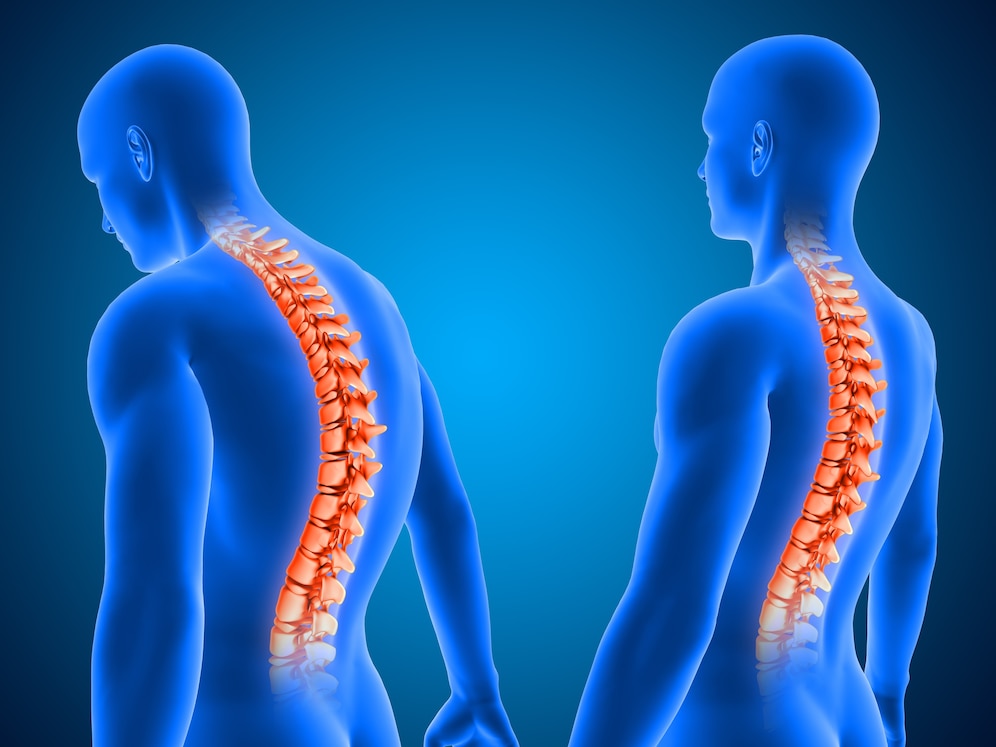 Benefits of Good Posture Image- Image shows bad posture against good on the Spine 